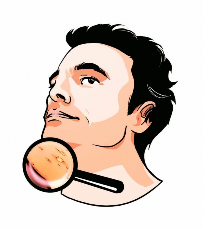 Rasurproblem Pickel 01.jpg